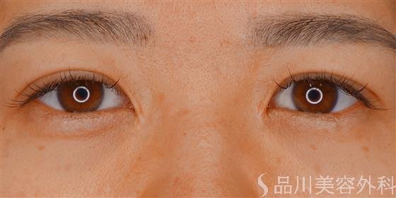 症例NO.59195のAFTER写真