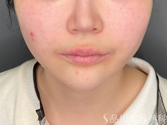 症例NO.70402のAFTER写真