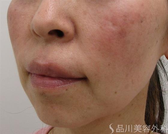 症例NO.43619のBEFORE写真