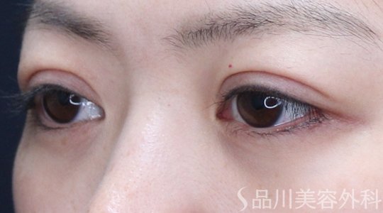 症例NO.74047のAFTER写真