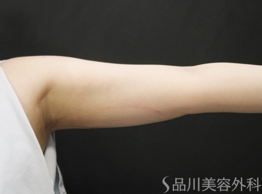 症例NO.75190のBEFORE写真