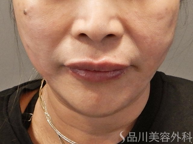 症例NO.72150のAFTER写真