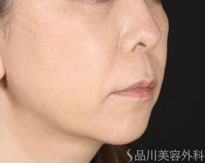 症例NO.72514のAFTER写真