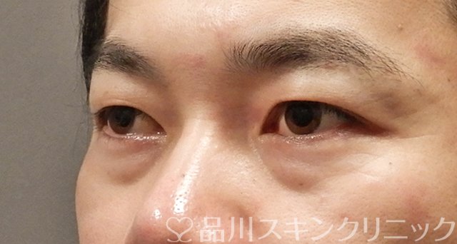 症例NO.66977のBEFORE写真