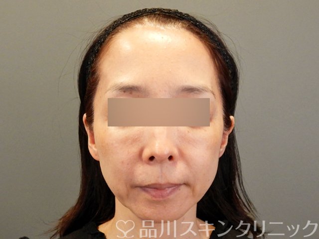 症例NO.66978のBEFORE写真