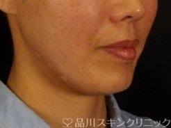 症例NO.72355のAFTER写真