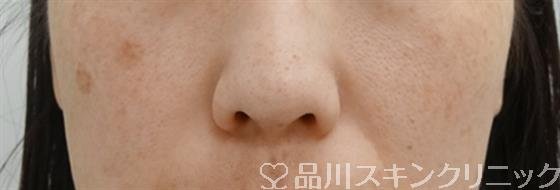 症例NO.26121のAFTER写真