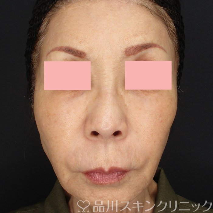 症例NO.71473のAFTER写真