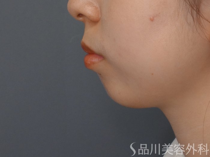 症例NO.65416のBEFORE写真