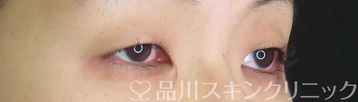 症例NO.67979のBEFORE写真