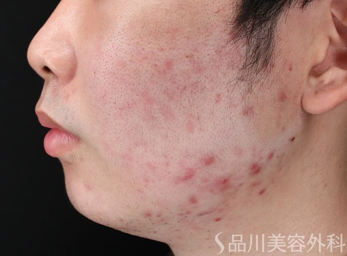 症例NO.69228のBEFORE写真