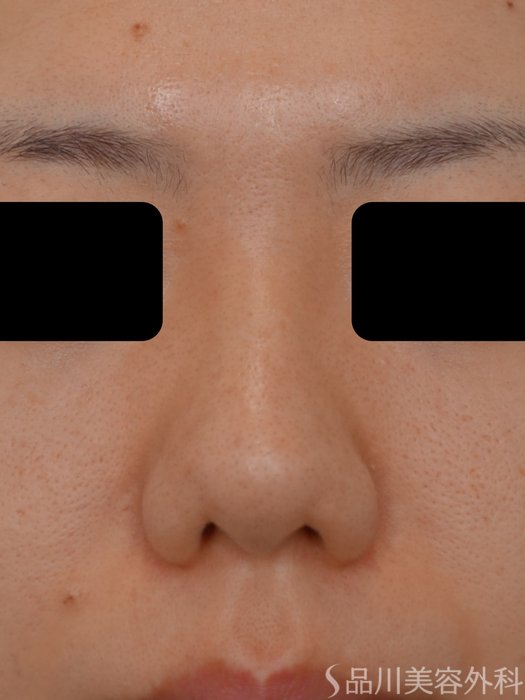 症例NO.74328のBEFORE写真