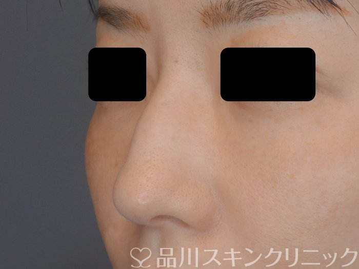 症例NO.71874のBEFORE写真