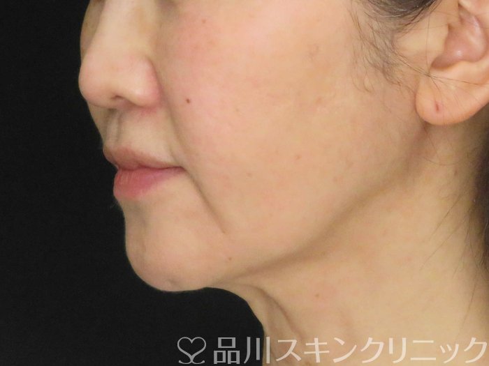 症例NO.65063のBEFORE写真