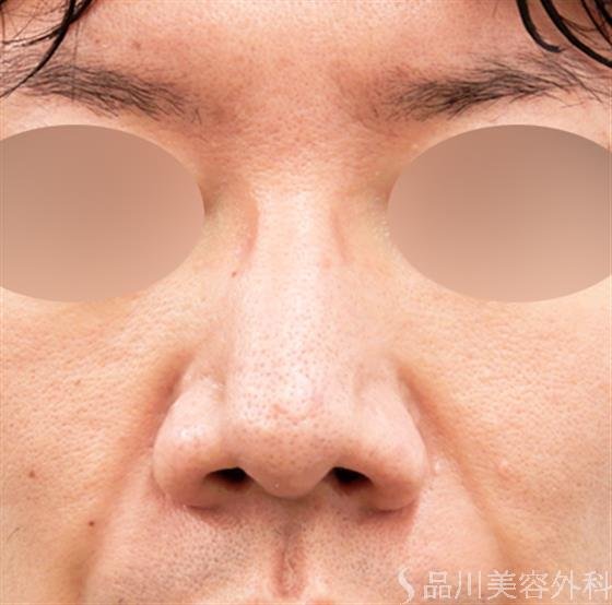 症例NO.53008のBEFORE写真