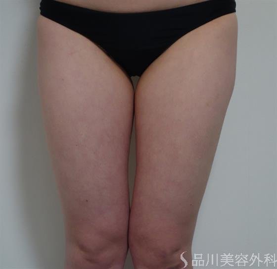 症例NO.36747のAFTER写真