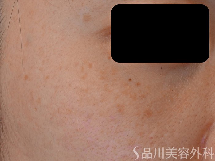 症例NO.72780のBEFORE写真