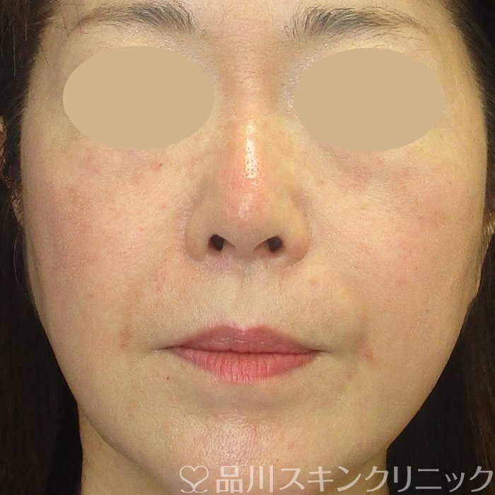 症例NO.73542のAFTER写真