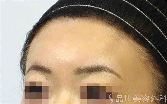 症例NO.33023のAFTER写真