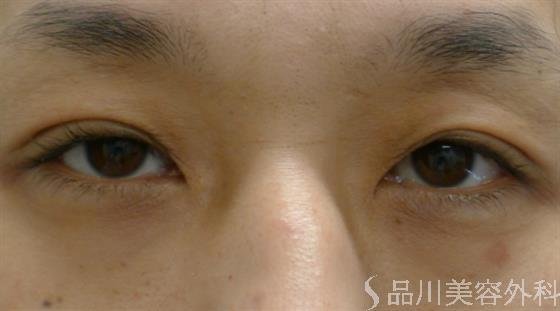 症例NO.38309のAFTER写真