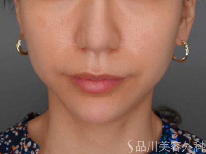 症例NO.73196のAFTER写真