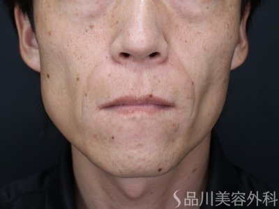 症例NO.75282のBEFORE写真