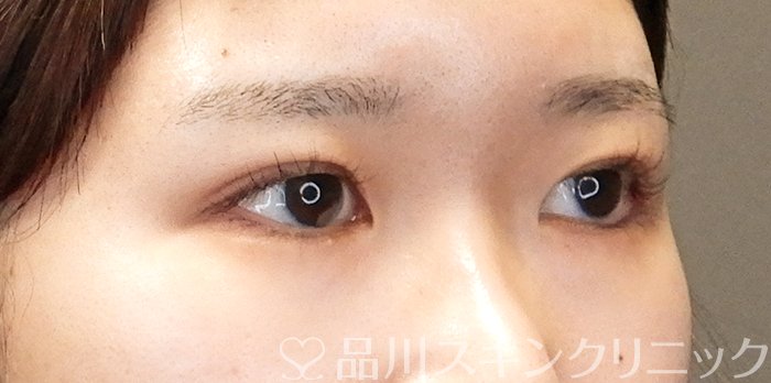 症例NO.63670のAFTER写真