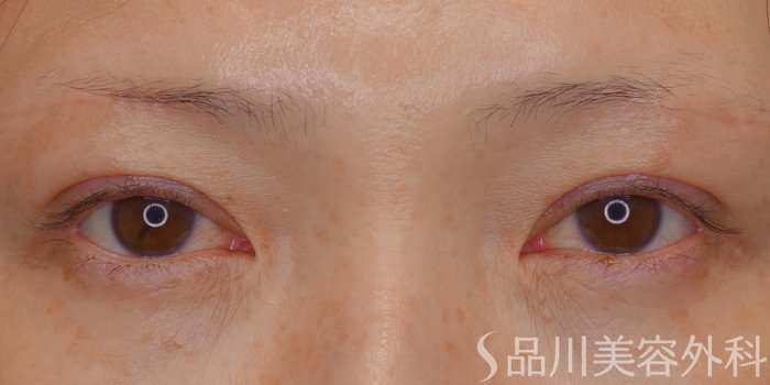 症例NO.68971のAFTER写真