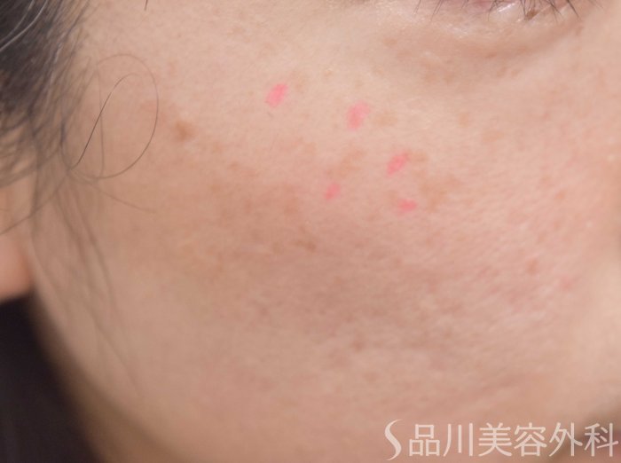 症例NO.66262のBEFORE写真