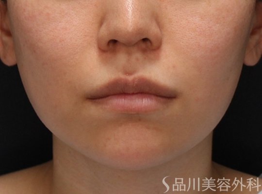 症例NO.74949のBEFORE写真