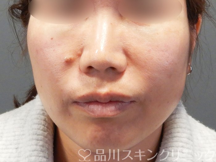 症例NO.73241のAFTER写真