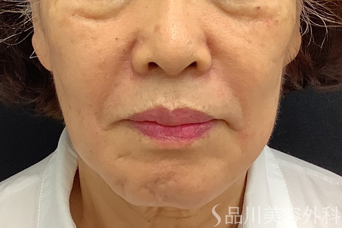 症例NO.71242のAFTER写真