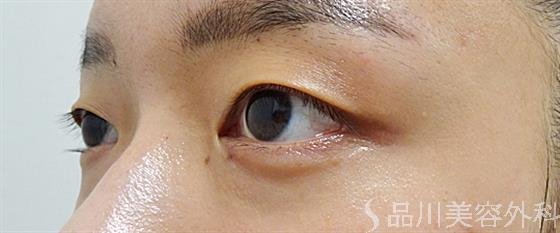 症例NO.54017のBEFORE写真