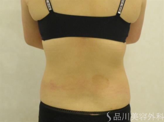 症例NO.41065のAFTER写真
