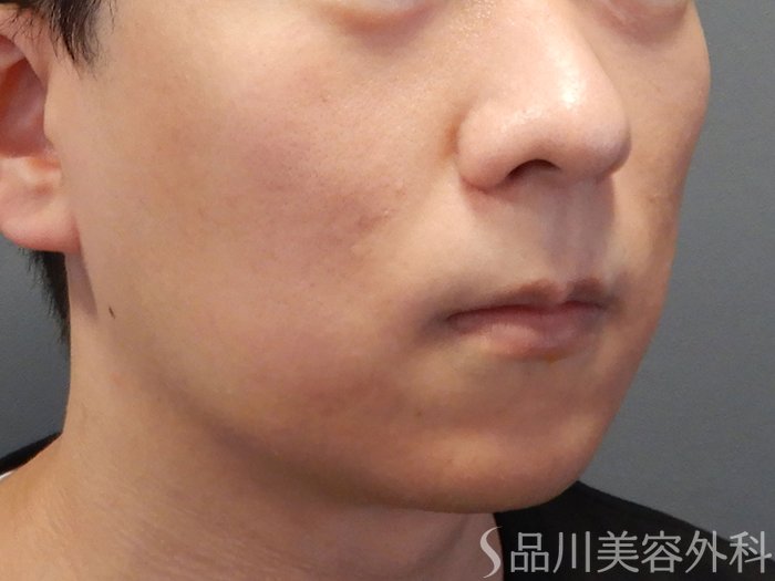 症例NO.73628のAFTER写真