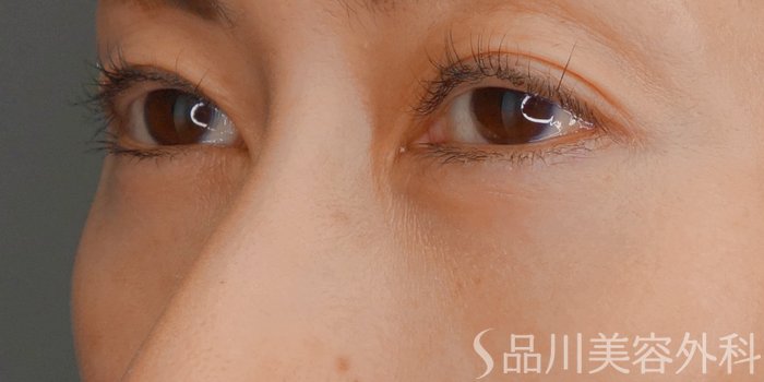 症例NO.62280のAFTER写真