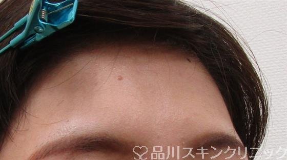 症例NO.32055のBEFORE写真