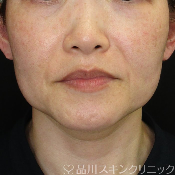 症例NO.73790のBEFORE写真