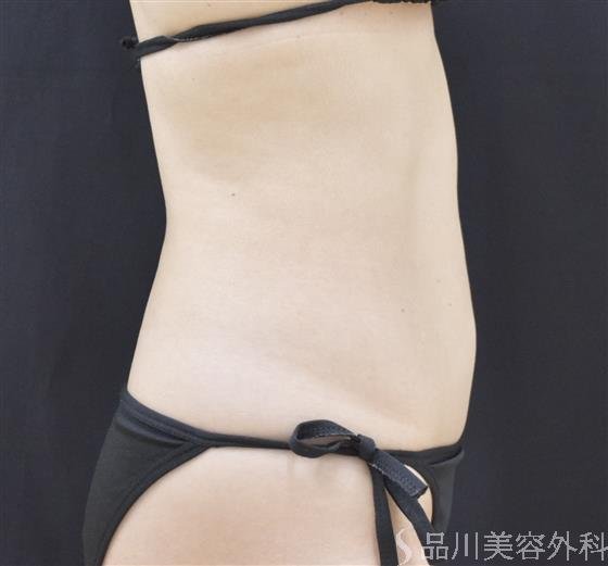 症例NO.50003のAFTER写真