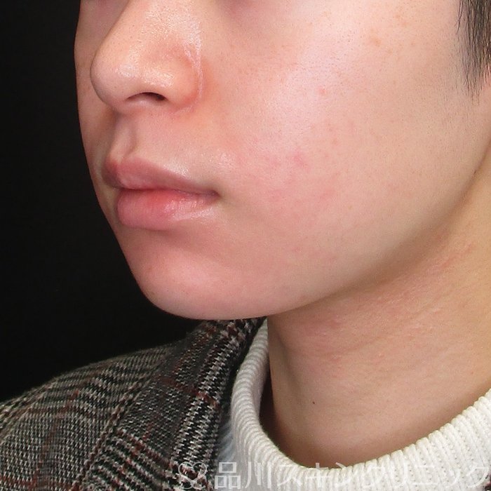 症例NO.72806のBEFORE写真