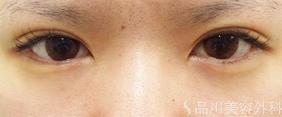 症例NO.33250のAFTER写真