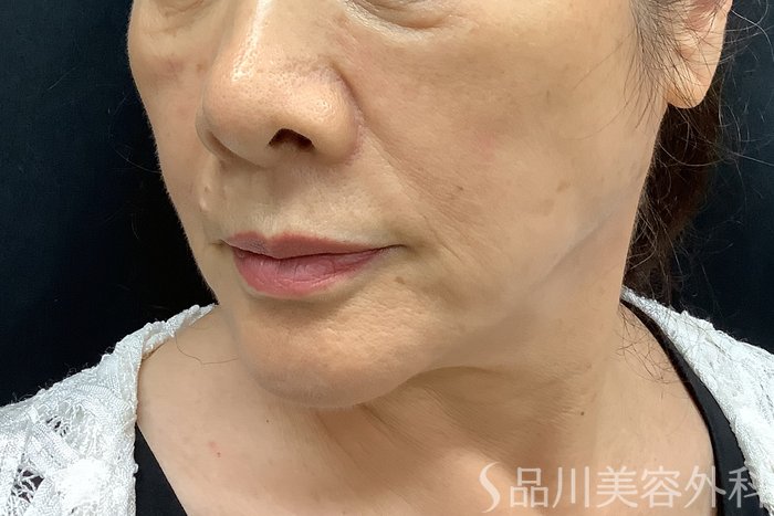 症例NO.69839のBEFORE写真