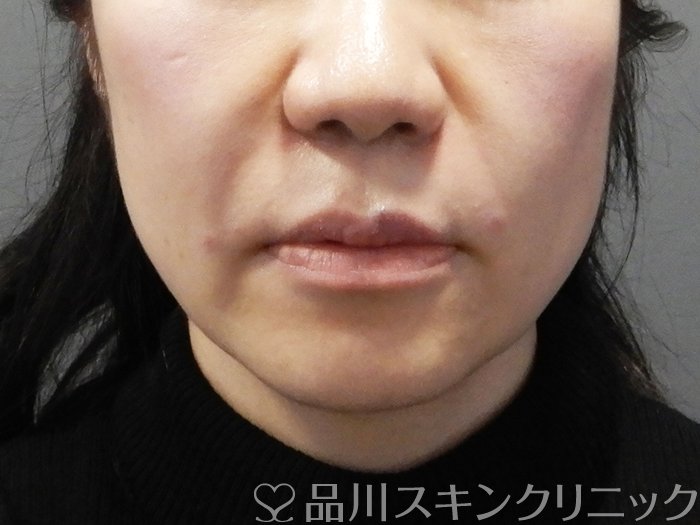 症例NO.73000のAFTER写真