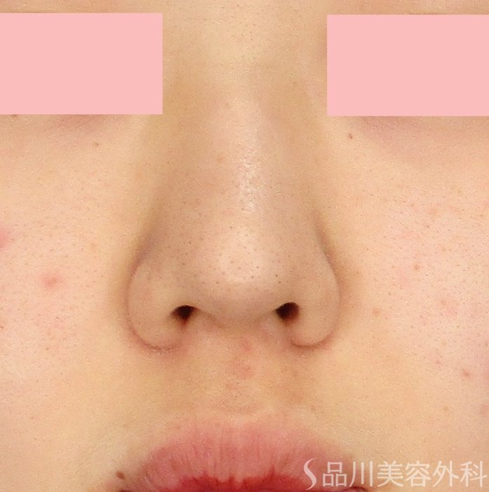 症例NO.71663のAFTER写真