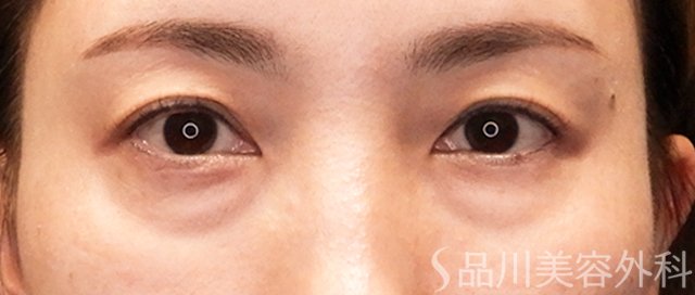 症例NO.71085のBEFORE写真