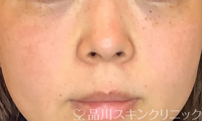 症例NO.69922のAFTER写真