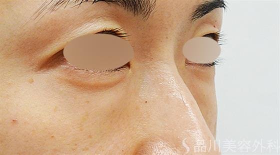 症例NO.49211のBEFORE写真