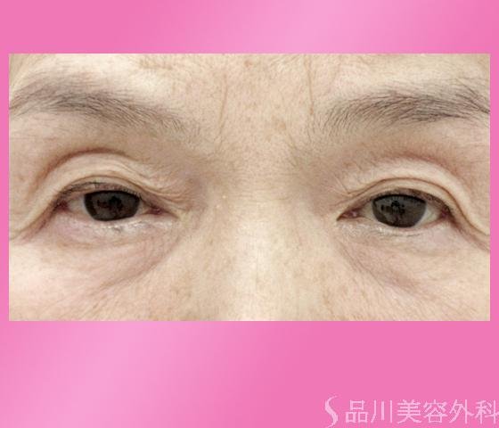 症例NO.1739のBEFORE写真