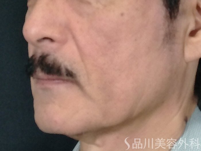 症例NO.70697のBEFORE写真