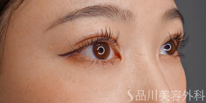 症例NO.73506のAFTER写真